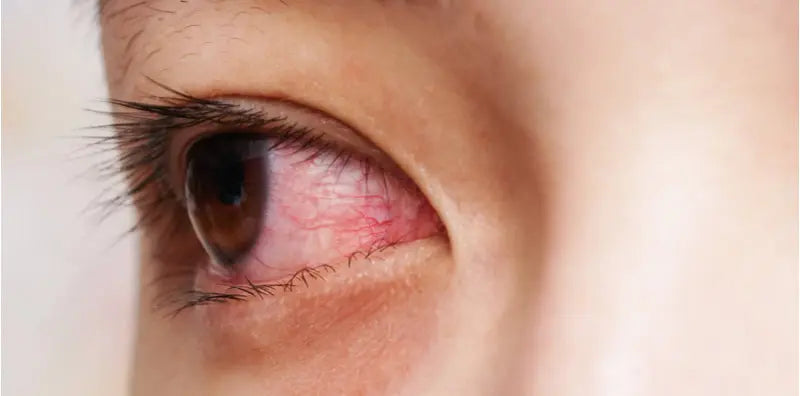 Eyelash Glue Allergies: Common Reactions and How to Prevent Them